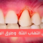التهاب اللثة