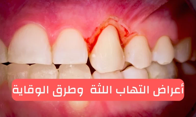 التهاب اللثة