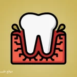 Treatment of Gum Inflammation, swollen gums