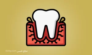 Treatment of Gum Inflammation, swollen gums