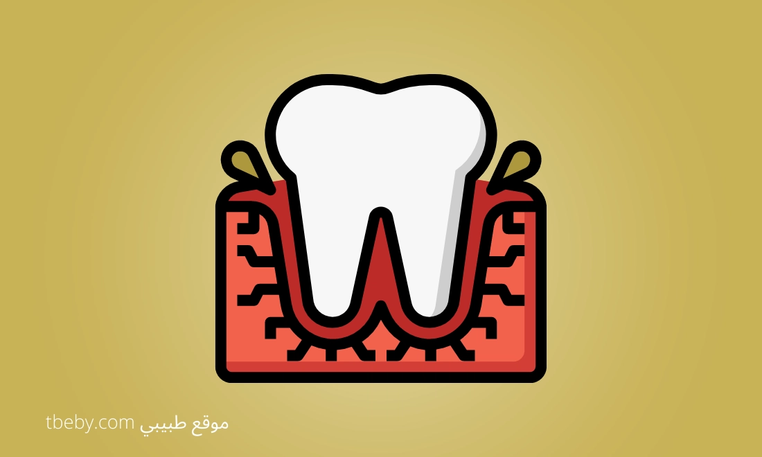 Treatment of Gum Inflammation, swollen gums