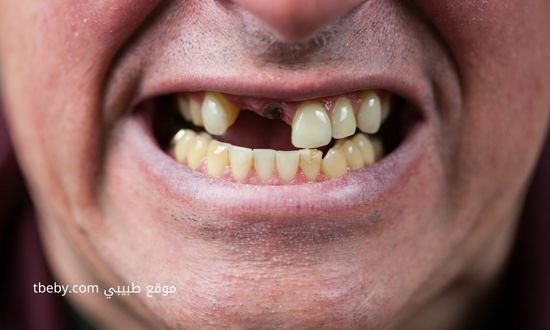 كيف أخلع الضرس في البيت؟