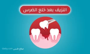 When Does Bleeding Stop After Tooth Extraction?