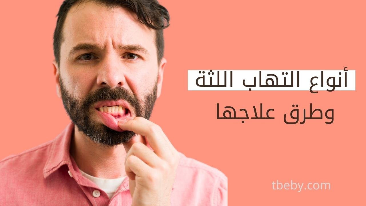 انواع التهاب اللثة