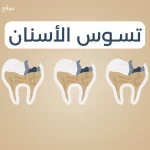 اعراض تسوس الاسنان وعلاجها 2026