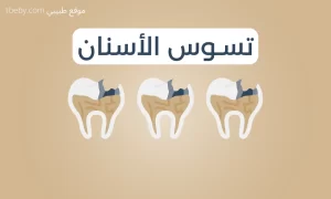 اعراض تسوس الاسنان وعلاجها 2026