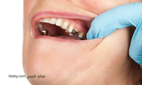 افضل معجون اسنان لعلاج التسوس