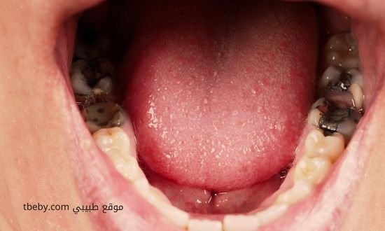 افضل معجون اسنان لعلاج التسوس