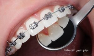 التقويم المعدني “metal braces”