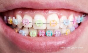 التقويم السيراميكي “ceramic braces”