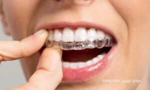 التقويم اللامرئي “invisible braces”