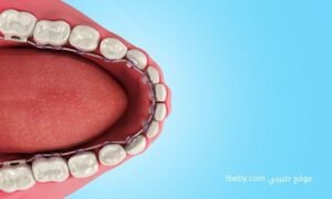 التقويم اللساني “lingual braces”
