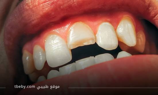 عمية زراعة الأسنان متى نلجأ إليها