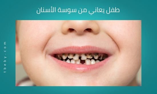 سوسة الاسنان للأطفال
