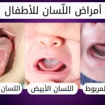 أمراض اللسان عند الأطفال