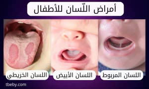 أمراض اللسان عند الأطفال