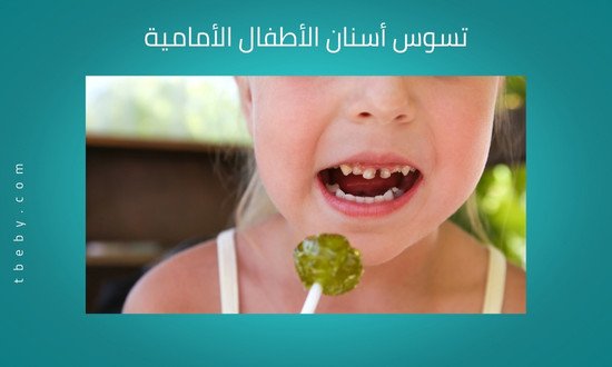 تسوس أسنان الأطفال الأمامية