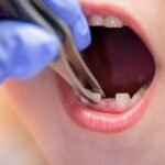 Tooth Extraction for Children