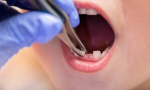 Tooth Extraction for Children