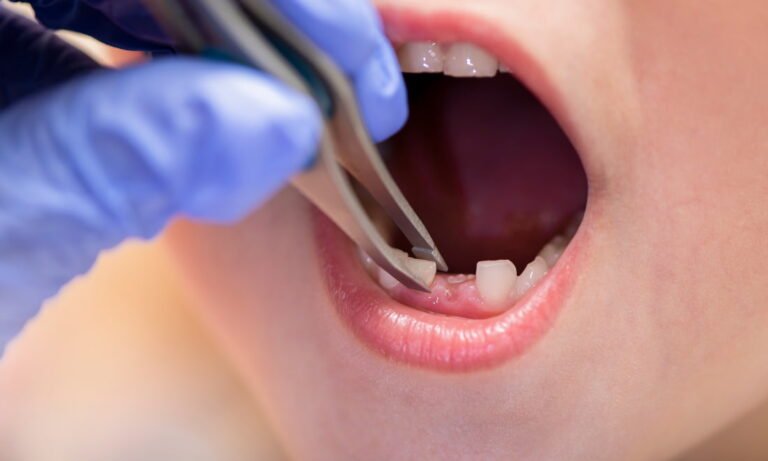Tooth Extraction for Children