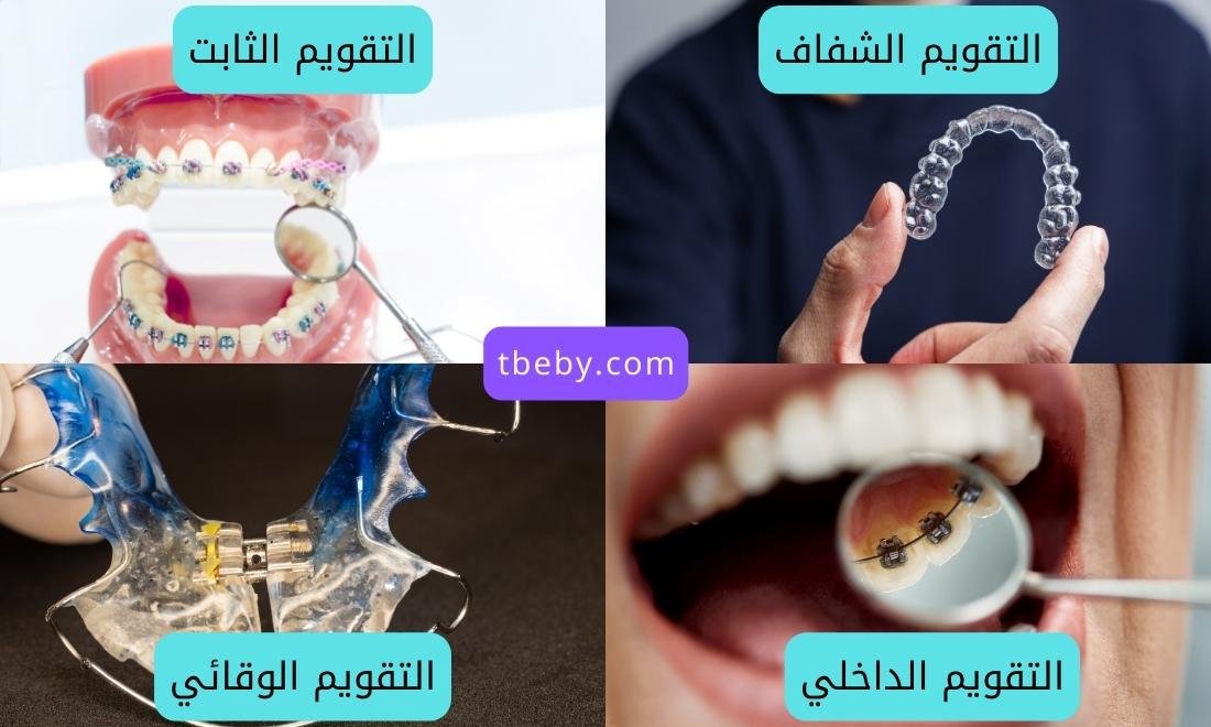 أنواع تقويم الأسنان
