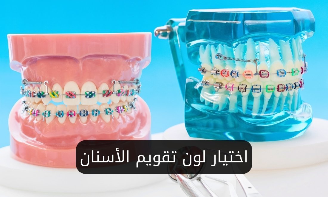 الوان تقويم الأسنان