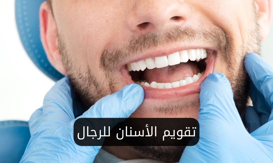 ألوان تقويم الأسنان