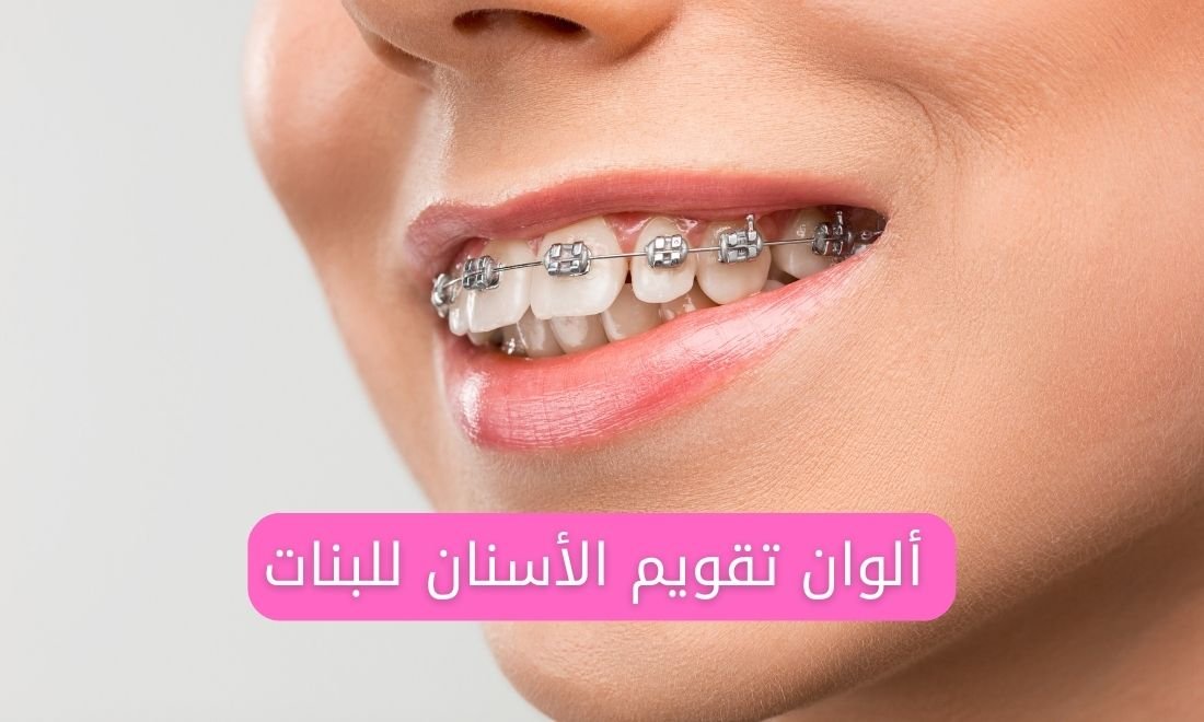 الوان تقويم الأسنان الخاصة بالبنات