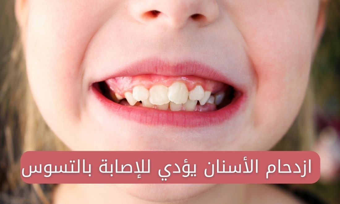 هل ازدحام الأسنان يسبب تسوس الأسنان عند الأطفال