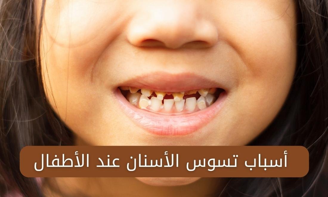أسباب تسوس الأسنان عند الأطفال