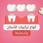 أنواع تركيبات الأسنان وأسعارها