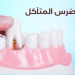 خلع الضرس المتآكل