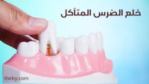 خلع الضرس المتآكل