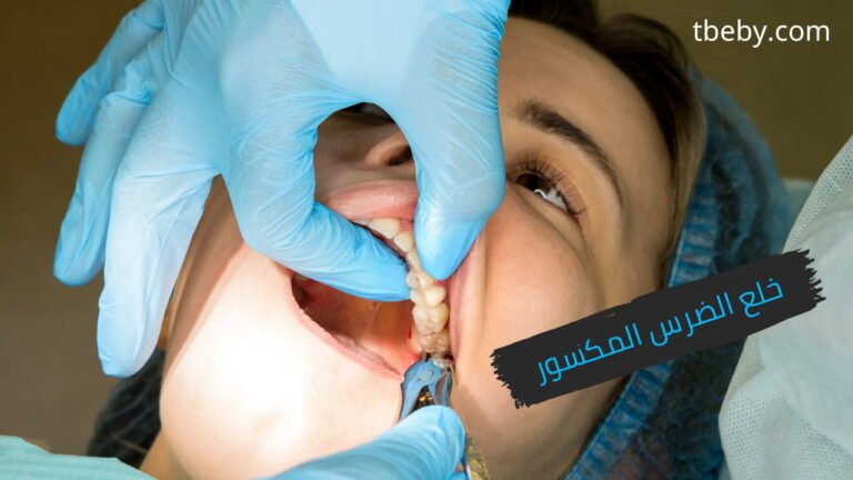 خلع الضرس المكسور