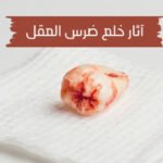آثار خلع ضرس العقل