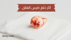 آثار خلع ضرس العقل