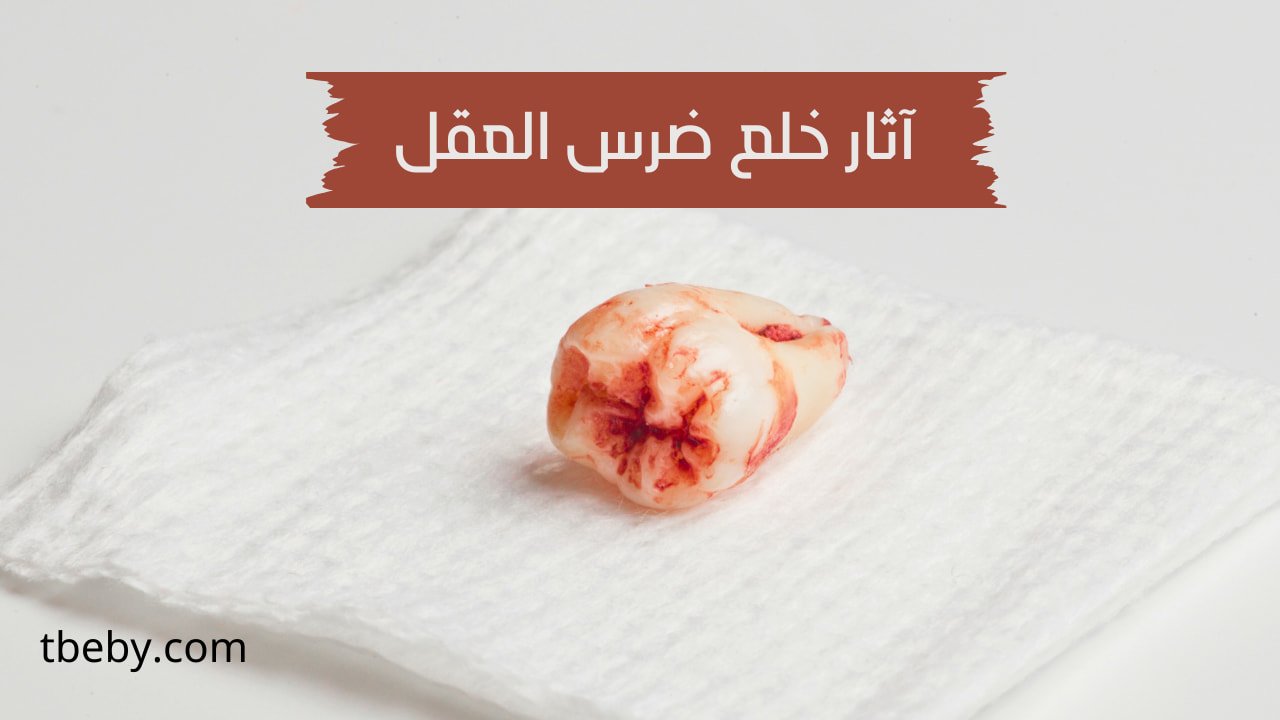 آثار خلع ضرس العقل