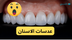 عدسات الاسنان – الأنواع والمميزات والعيوب والأسعار والكثير..