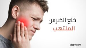 خلع الضرس الملتهب