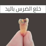 خلع الضرس باليد