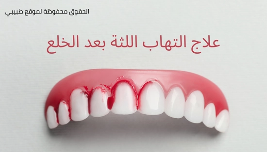 علاج التهاب اللثة بعد الخلع