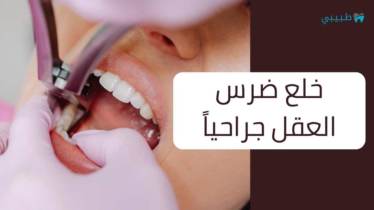 خلع ضرس العقل جراحيا