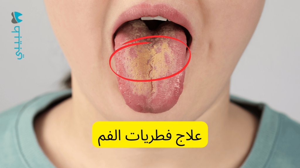 علاج فطريات الفم