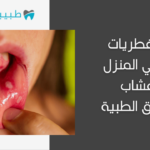 علاج فطريات الفم في المنزل بالأعشاب وبالطرق الطبية
