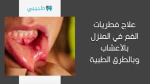 علاج فطريات الفم في المنزل بالأعشاب وبالطرق الطبية