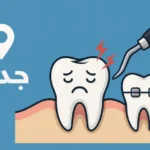 خلع ضرس العقل جدة
