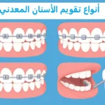 أنواع تقويم الأسنان المعدني