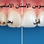 تسوس الاسنان الامامية قبل وبعد