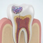 علاج-تسوس-الأسنان-بالأعشاب-نهائيا