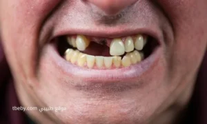 Extracting Baby Teeth at Home